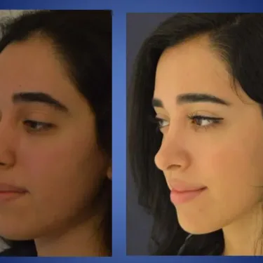 Ринопластика