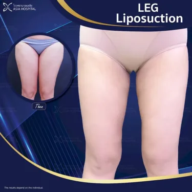Thigh liposuction