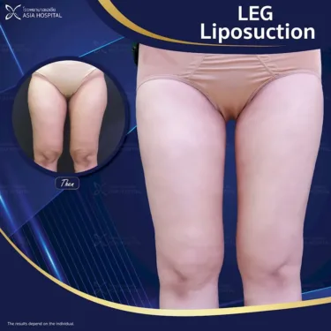 Thigh liposuction