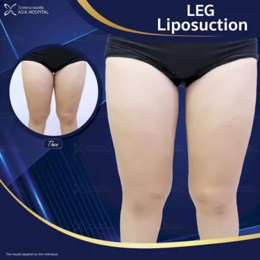 Thigh liposuction