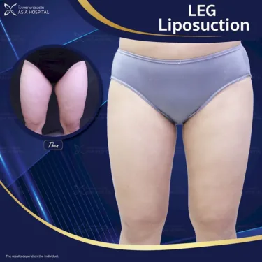 Thigh liposuction