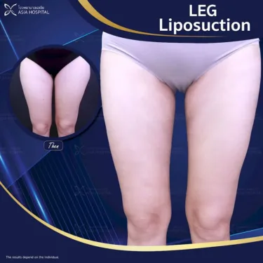 Thigh liposuction