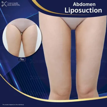Thigh liposuction