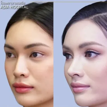 Пластика носа