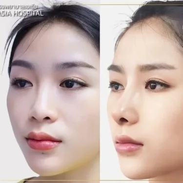 Пластика носа