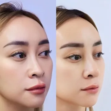 Пластика носа