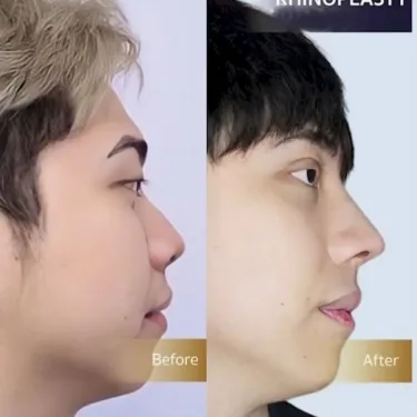 Пластика носа