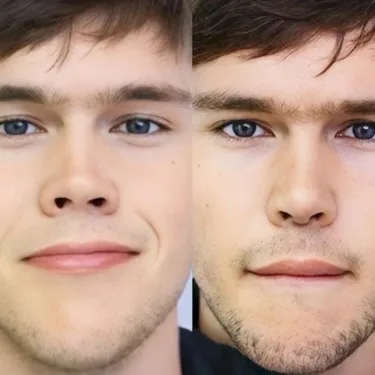 Пластика носа