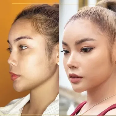 Пластика носа