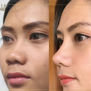 Пластика носа