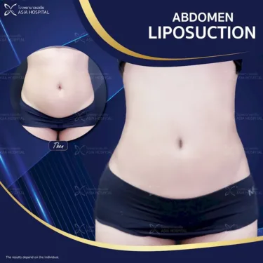 Abdominal liposuction