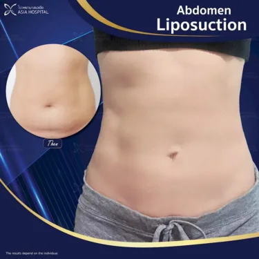 Abdominal liposuction