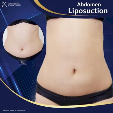 Abdominal liposuction