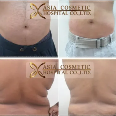 Vaser liposuction 360