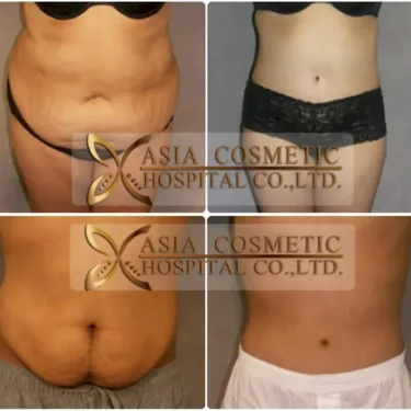 Vaser liposuction 360