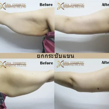 Arm liposuction with lift