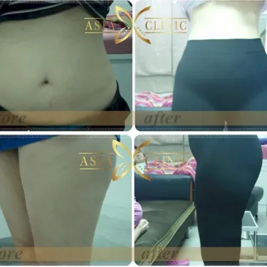 Vaser liposuction 360