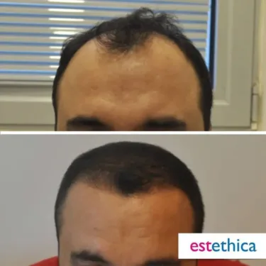 Hair Transplant