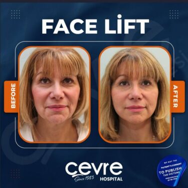 Подтяжка лица