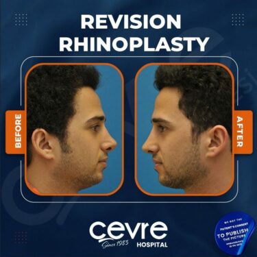 Ринопластика