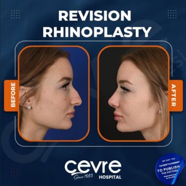 Ринопластика