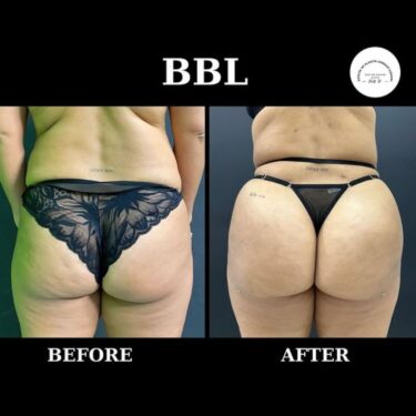 Бразильская подтяжка ягодиц (BBL)
