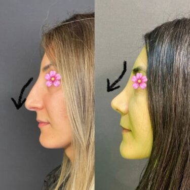 Ринопластика