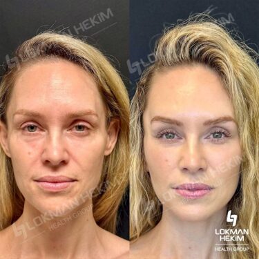 Пластическая хирургия лица