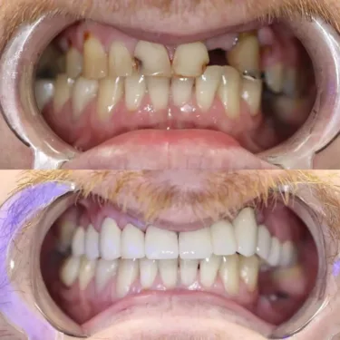 Зубные имплантаты