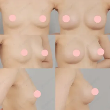 Breast augmentation