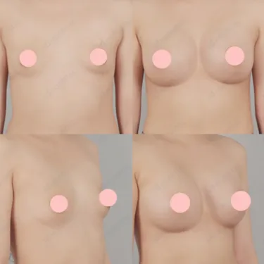 Breast augmentation