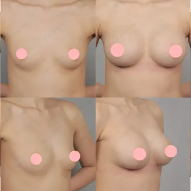Breast augmentation