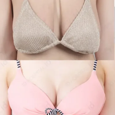 Breast lift
