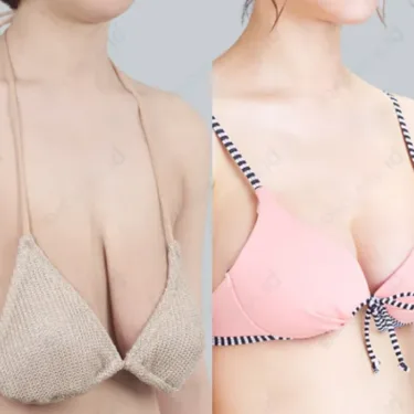 Breast lift