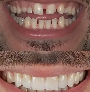 Зубные имплантаты