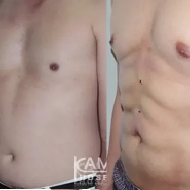 Абдоминопластика Six-pack abs