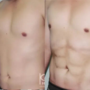 Абдоминопластика Six-pack abs