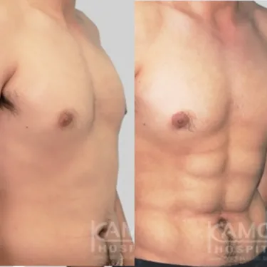 Абдоминопластика Six-pack abs