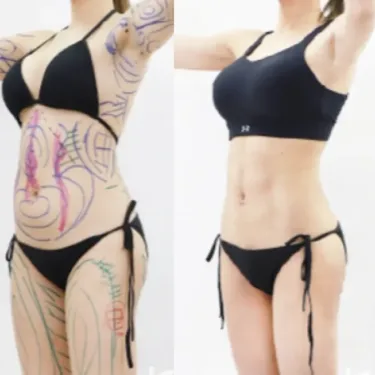Абдоминопластика Six-pack abs
