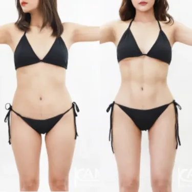 Абдоминопластика Six-pack abs
