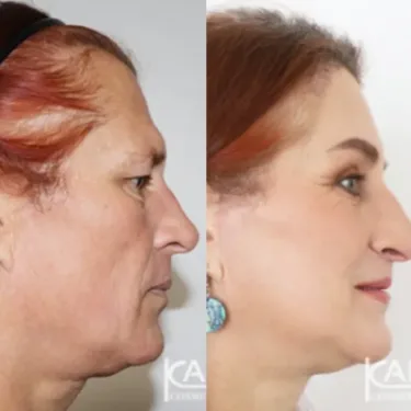 Изменение пола (из мужчины в женщину)