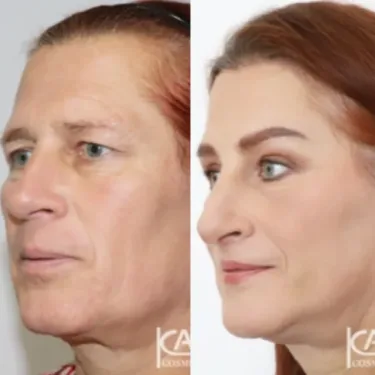 Изменение пола (из мужчины в женщину)