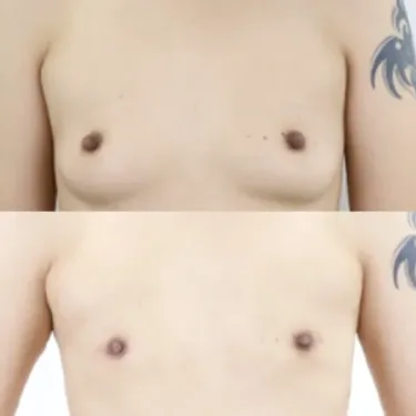 Мастэктомия при изменении пола