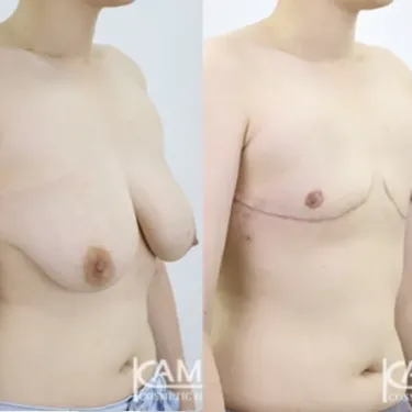 Мастэктомия при изменении пола