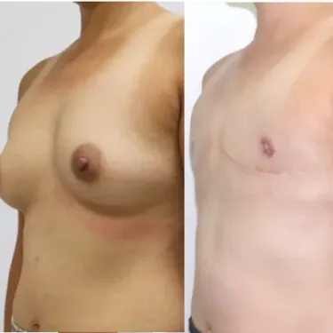 Мастэктомия при изменении пола