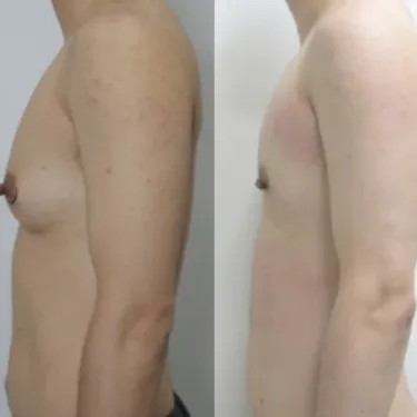 Мастэктомия при изменении пола