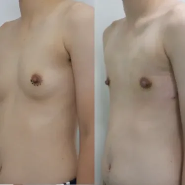 Мастэктомия при изменении пола