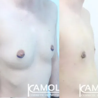 Мастэктомия при изменении пола