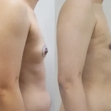 Мастэктомия при изменении пола