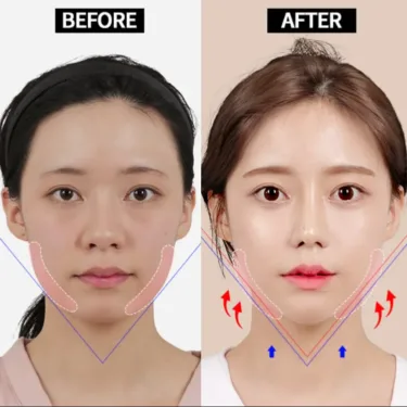 Контурная пластика лица